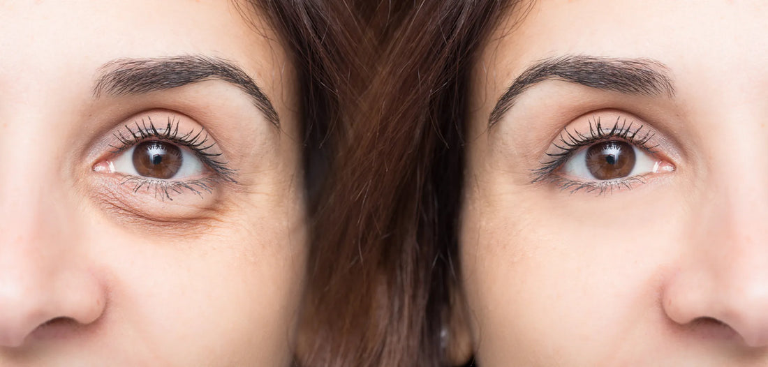 Best Skin Care Practices for Reducing Under-Eye Puffiness