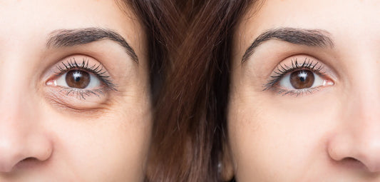 Best Skin Care Practices for Reducing Under-Eye Puffiness